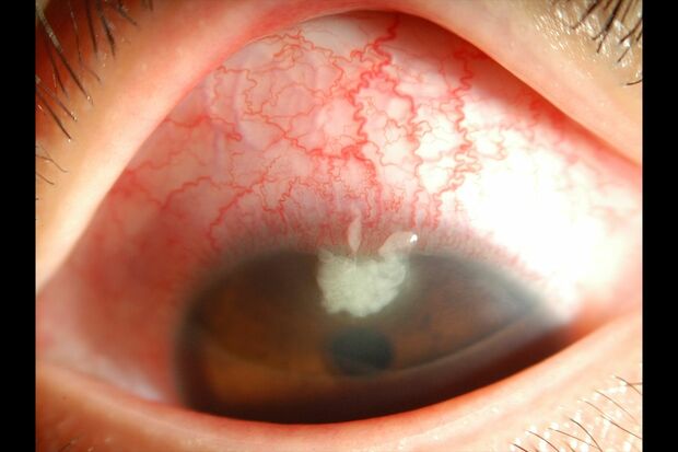 角膜潰瘍（かくまくかいよう）（写真提供／糸井素純）