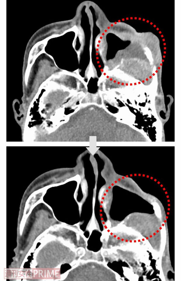 【症例1：70代男性 左上顎洞がん】BNCT治療前後のCT画像