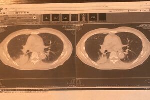 肺がんの治療前とその後。MRI、エックス線でもやや小さくなったことを確認。放射線治療など計画を変えてがんを弱める可能性も