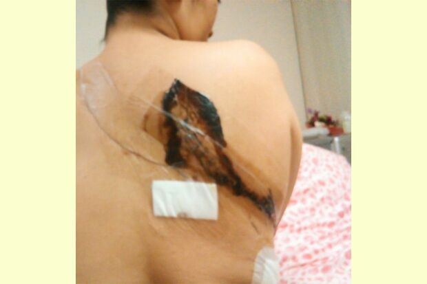 肺に転移したがんを摘出した際の背中の傷痕。痛みでしばらく横になって眠れなかったという