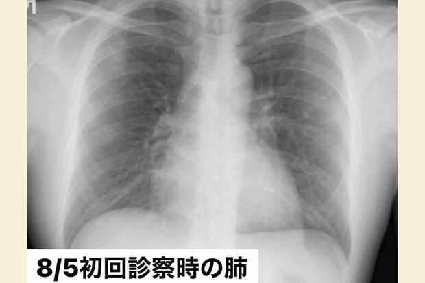 8月5日、「東京都発熱相談センター」で紹介された病院でのレントゲン写真。まだ肺はキレイだった（写真：取材者提供／東洋経済オンライン）