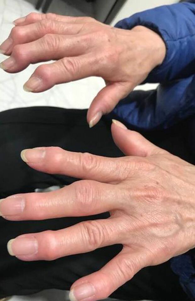 変形性関節症による指の「痛み」「しびれ」