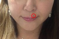 高須クリニックで“ババ見えホクロ”を取ってみた「びっくりするほど短時間で、痛みがない！」