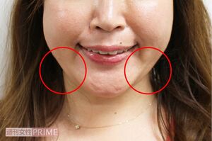 両頰の下の肉が気になる……