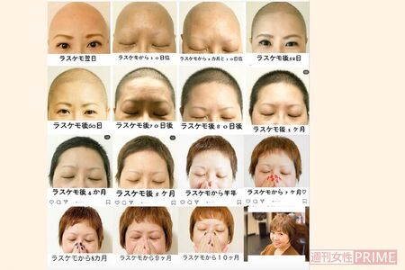 ラスケモとは「ラスト毛もっと」の略で最後の抗がん剤治療のことを指す言葉 提供/さくらさん