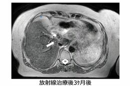 放射線治療後3か月では、ほとんどがんが見えなくなっている(画像提供:GenesisCare)