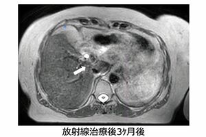 放射線治療後3か月では、ほとんどがんが見えなくなっている（画像提供:GenesisCare）
