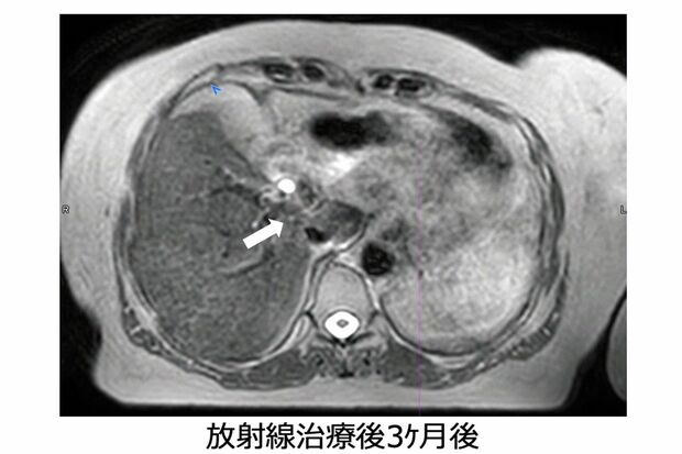 放射線治療後3か月では、ほとんどがんが見えなくなっている（画像提供:GenesisCare）