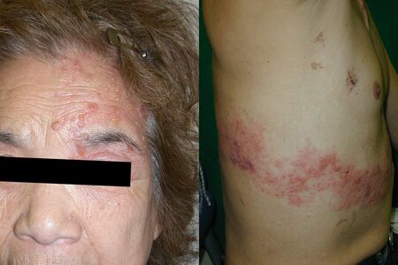 おでこやお腹周りなどに出た症状。発疹が広範囲に及ぶ場合も