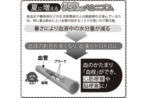 夏に増える梗塞のメカニズム