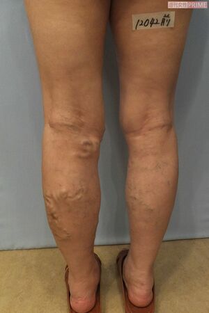 下肢静脈瘤は、足の静脈が太くなり、瘤状に浮き出て見えるようになった状態で、高齢の女性がなりやすい病気