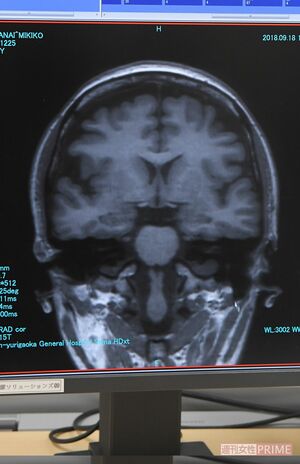 ライターのMRI画像