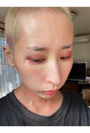 抗がん剤治療の副作用で皮膚障害が出て、頬に赤い発疹が