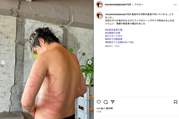 クラゲに刺されてしまったことを報告するウーマンラッシュアワーの村本大輔(公式インスタグラムより)