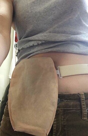 直腸摘出後、3か月期間限定でつけることになった人工肛門と、便をためるためのパウチ