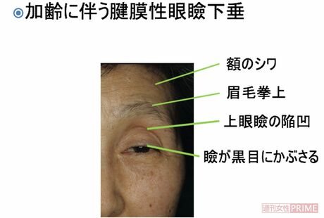 加齢にともなう腱膜性眼瞼下垂の症状 写真提供=小室主任教授