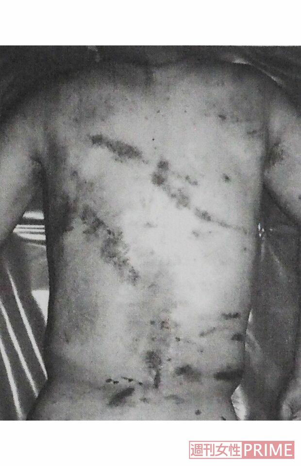 Aさんの遺体の背中には複数の大きなアザが生々しく残っていた