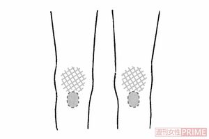 「ひざのねじれ」（イラスト／日江井香）