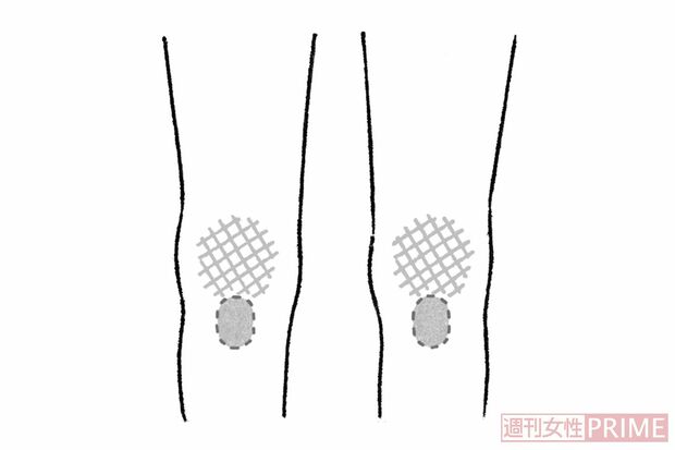 「ひざのねじれ」（イラスト／日江井香）