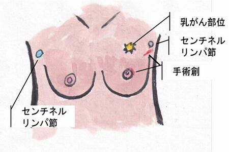 乳がんの部位を迫田綾子さんがイラスト化したもの