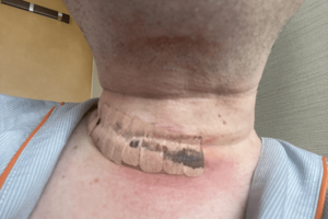 術後翌日。首の傷部にテープを貼っている