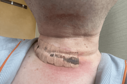 術後翌日。首の傷部にテープを貼っている