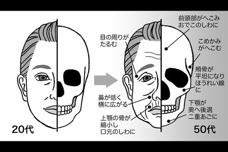 骨ちぢみが老け見えに直結!前頭部の骨がへこめば額の皮膚がたるみ、頬骨が減って平坦になれば頬がこけ、ほうれい線が深まる。