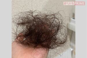 脱け毛の量は普段の3倍になったという（鈴木さん提供）
