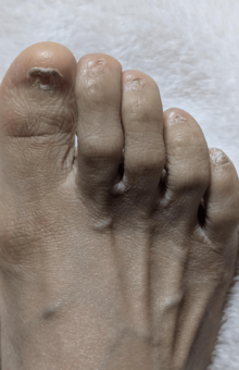 副作用で失った足の爪は、2年半以上たっても親指以外は生えてこない