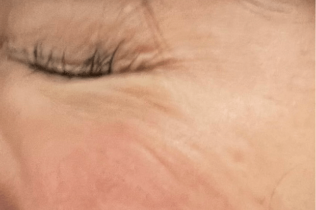 術後2週間。目尻施術後。瞼を強く閉じると術前と比べて明らかにシワがよりにくい！凄い！