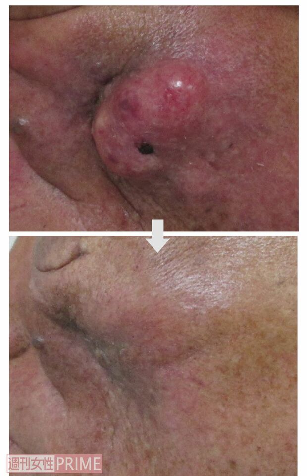 【症例1：70代男性左上顎洞がん】BNCT治療前後の頬の様子。左頬の表面に現れた赤みや膨らみもなくなった