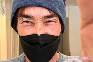 放射線治療後、マスクの跡が残る顔