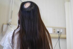 手術後、傷がだいぶ落ち着いたころ。お腹の皮膚を移植した部分は髪が生えないので、いつも隠していた