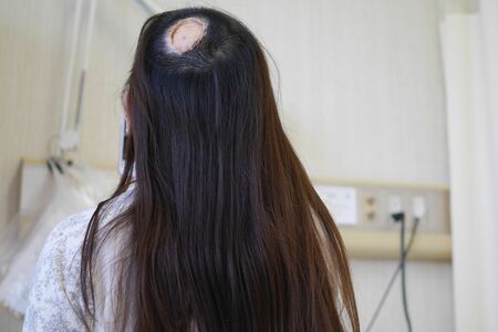 手術後、傷がだいぶ落ち着いたころ。お腹の皮膚を移植した部分は髪が生えないので、いつも隠していた