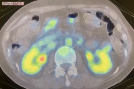 54歳のときに、がん細胞の様子を確認するためのPET検査をした際の写真。白丸部分ががん細胞の疑いありと診断され、詳しい検査の後、抗がん剤治療をスタートすることに(本人提供)