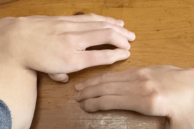 「手羽先」のように手が曲がって生まれたなみきさん。右腕は健常者より骨が少ない状態