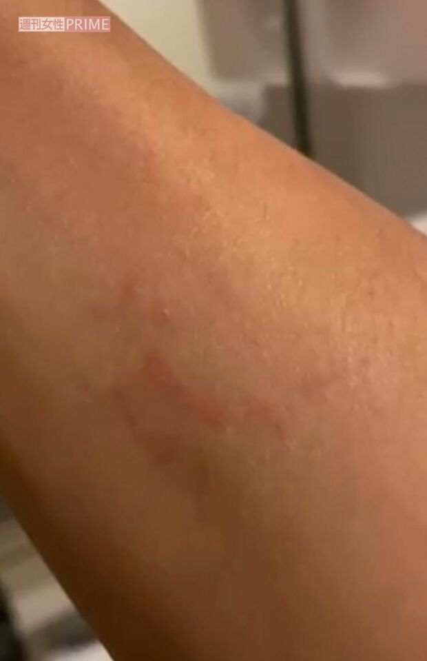 Ａ子からの暴力でできた、小澤の身体の傷2