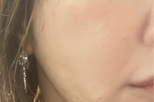 術後、2週間目！手を肌に当てても引っ掛かりがない！！