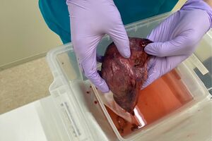 1割切除した自身の肺を「記念に撮ってもらいました」と笑顔で見せてくれた（本人提供）