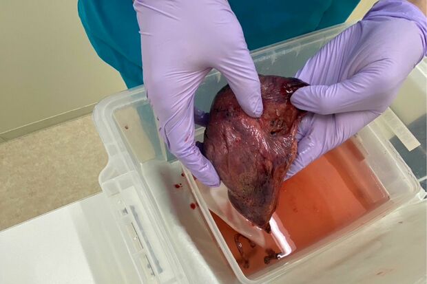 1割切除した自身の肺を「記念に撮ってもらいました」と笑顔で見せてくれた（本人提供）