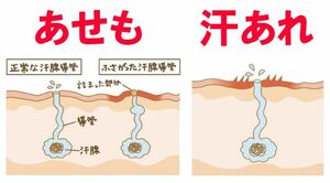 あせもは「運動などで大量の汗をかいた際に、汗を排出する管が詰まったもの」、汗あれは「汗をかいた後、汗に含まれるアンモニアなどの成分が刺激になり肌があれ、チクチク・ピリピリと感じるもの」