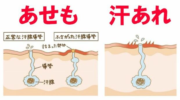 あせもは「運動などで大量の汗をかいた際に、汗を排出する管が詰まったもの」、汗あれは「汗をかいた後、汗に含まれるアンモニアなどの成分が刺激になり肌があれ、チクチク・ピリピリと感じるもの」