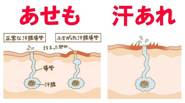 画像 写真 夏のお悩み そのかゆみ 汗あれ が原因かも 洗いすぎが引き金に 週刊女性prime
