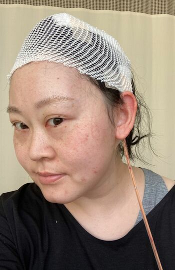 半年におよぶ再建手術、バルーン抜去直後。1年半かけて追加の手術などを行う