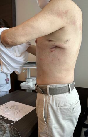 胸腔鏡でもやはり術後の痛みはつらかったと語る森田正光さん