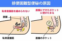 便秘解消の「おしり5秒体操」で、出したいのに出せない“新タイプ”の便秘を改善！