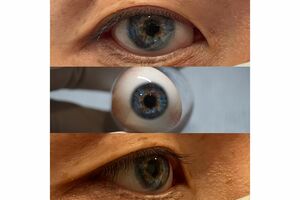 「おしゃれでかっこいい義眼を」というリクエストから作成した通称“アースアイ”