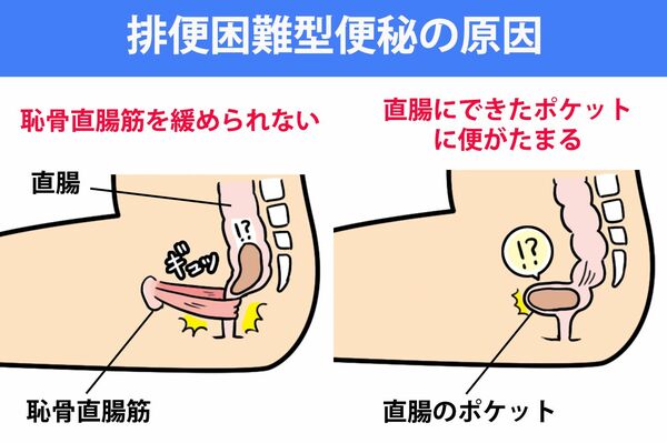 （左）「恥骨直腸筋」が直腸から肛門にかけての部分を締めつけているため排便できない。（右）直腸の一部がポケット状に変形して、そこに便がたまってしまう。
