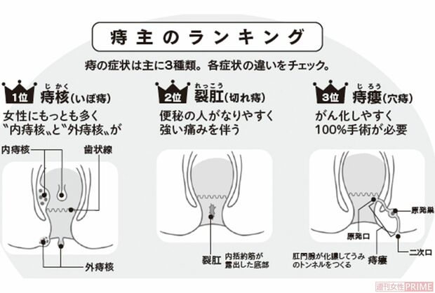痔主のランキング　イラスト／上田惣子