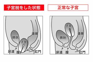 骨盤臓器脱も尿のトラブルに